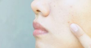 Clogged pores